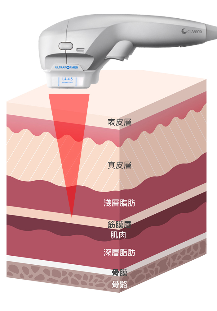 音波拉提作用位置示意